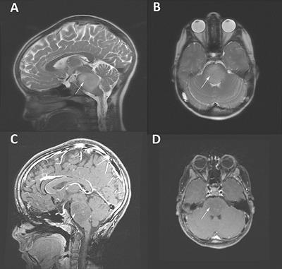 Treatment Strategies in Diffuse Midline Gliomas With the H3K27M Mutation: The Role of Convection-Enhanced Delivery in Overcoming Anatomic Challenges